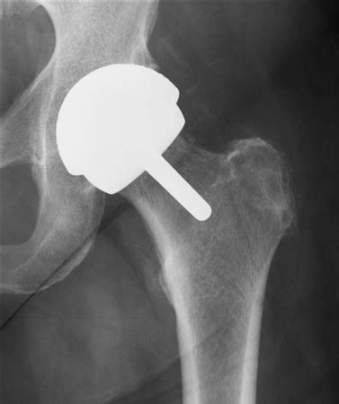 hip resurfacing orthobullets|Current indications for hip resurfacing arthroplasty in 2016.
